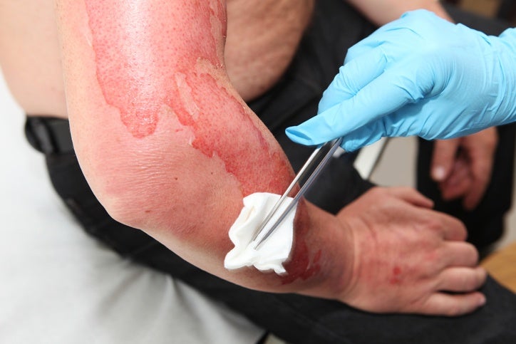 Burn Injuries Attorney in Riverside, CA